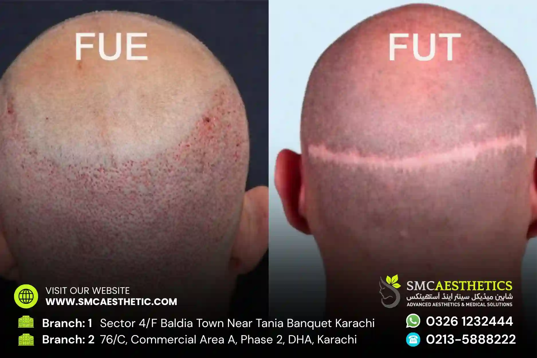 FUT Strip Hair Transplant Before and After Results - SMC Aesthetics Karachi